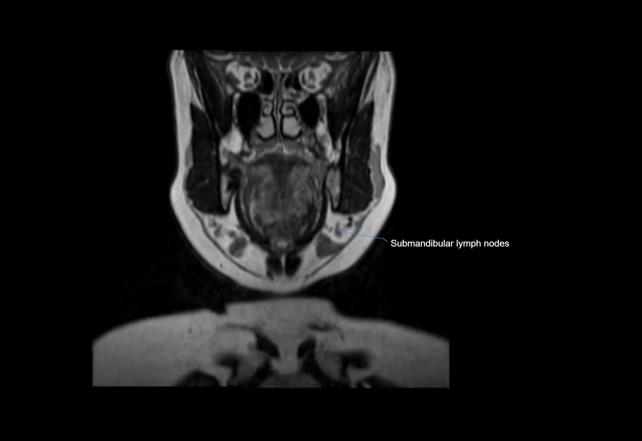 Neck coronal lymph node cross sectional MRI anatomy 3T MRI  image-img-00001-00053.webp